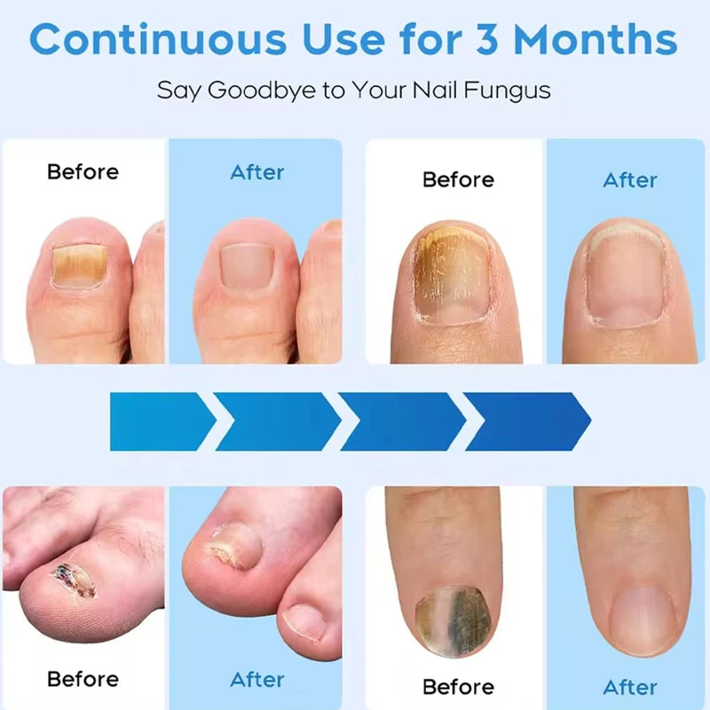 KTS Fungal Nail Laser Device For Toenail And Foot Care