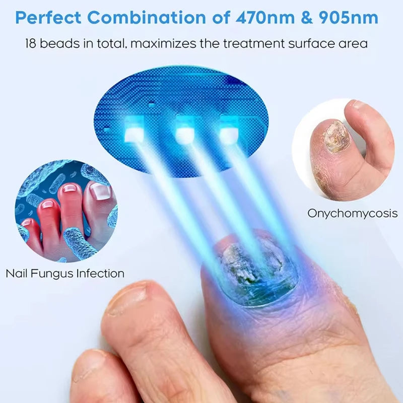 KTS Fungal Nail Laser Device For Toenail And Foot Care